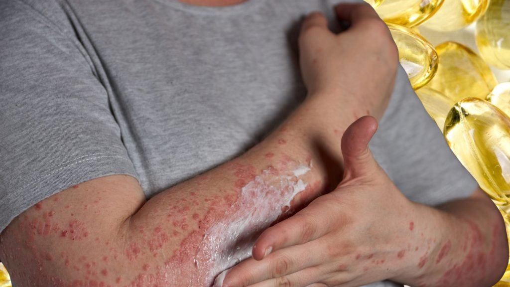 High-Dose Vitamin D3 Therapy in Psoriasis: Reassuring Data