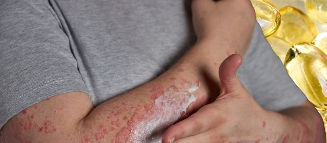 Psoriasis (1)